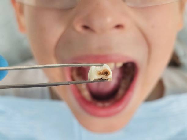 Best Emergency Dental Care for Broken or Chipped Teeth in Powell, OH